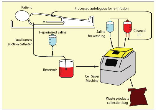Cell Salvage Machine